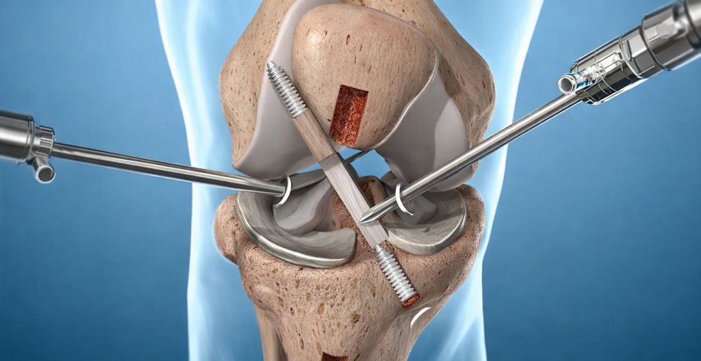 Knee Arthroscopy